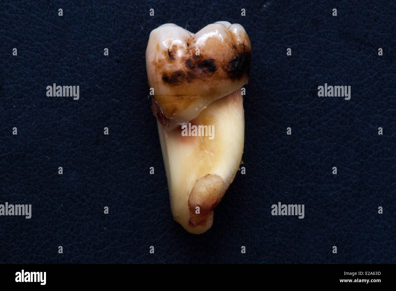 La dent a une grande cavité et a souffert profondément. Banque D'Images