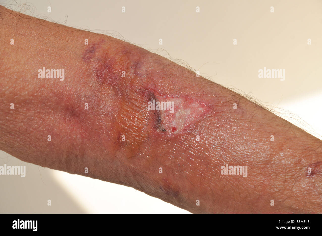 Plaie infectée Banque de photographies et d’images à haute résolution