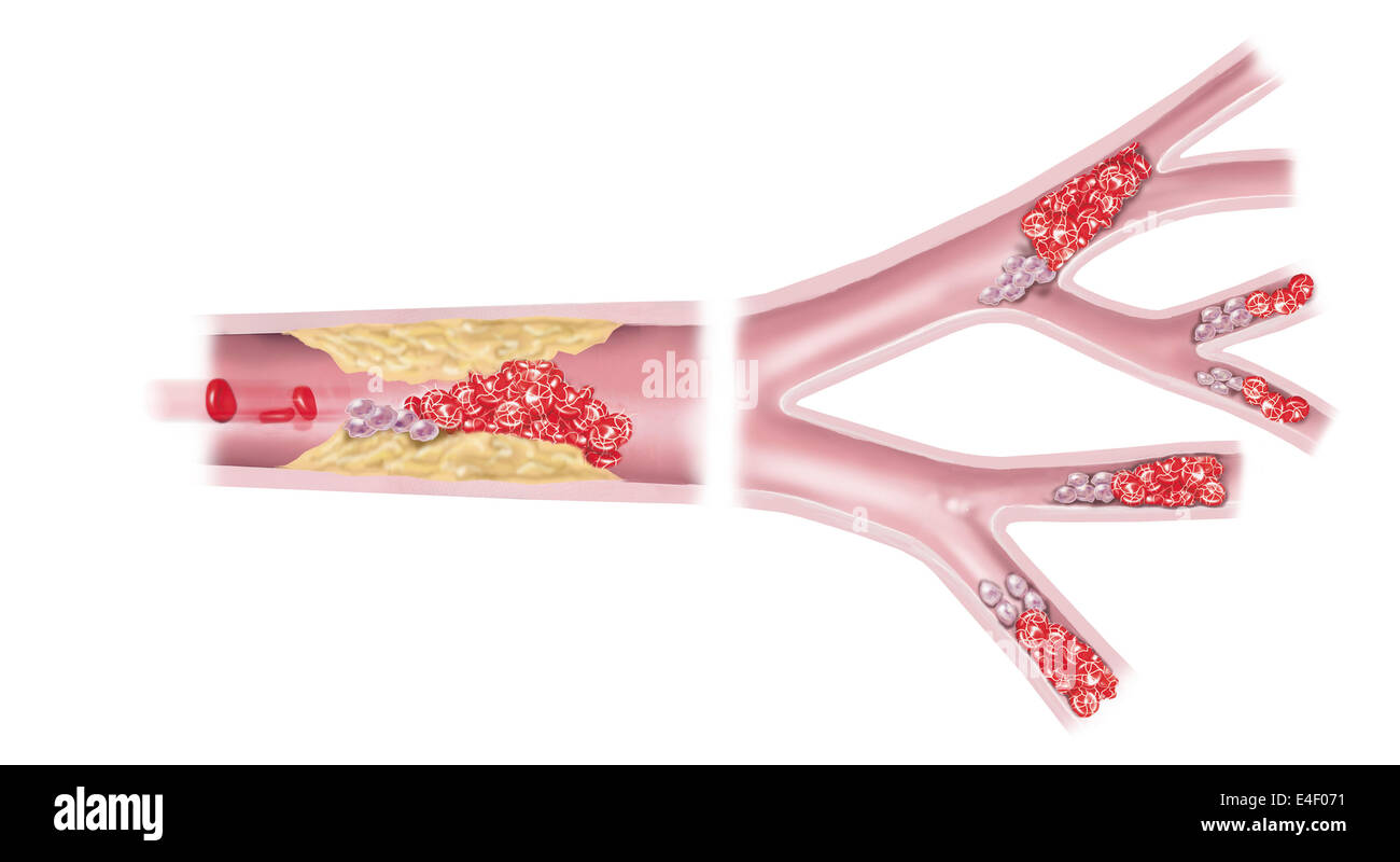 Syndrome coronarien aigu - l'obstruction microvasculaire. Banque D'Images