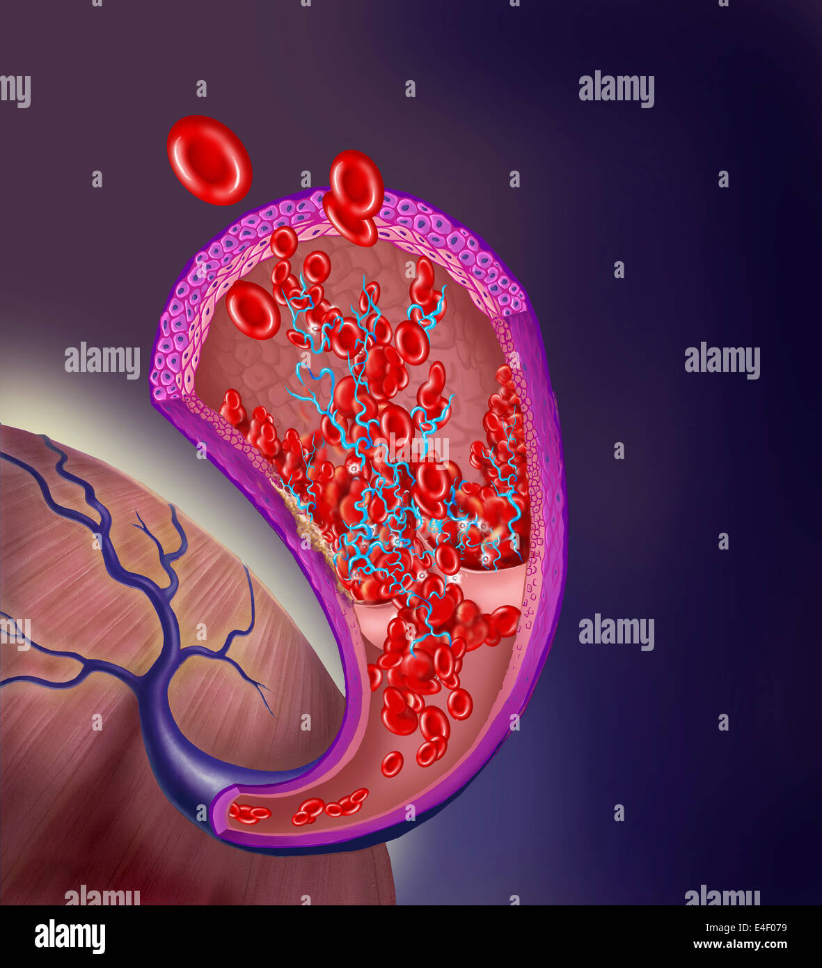 Le thrombus se forme sur l'intérieur de la soupape d'idées. Banque D'Images