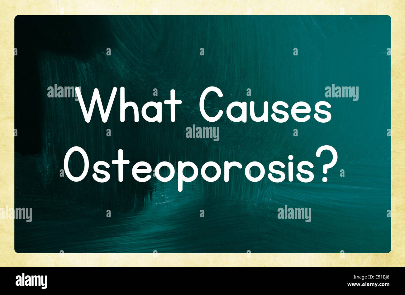 Quelles sont les causes de l'ostéoporose ? Banque D'Images