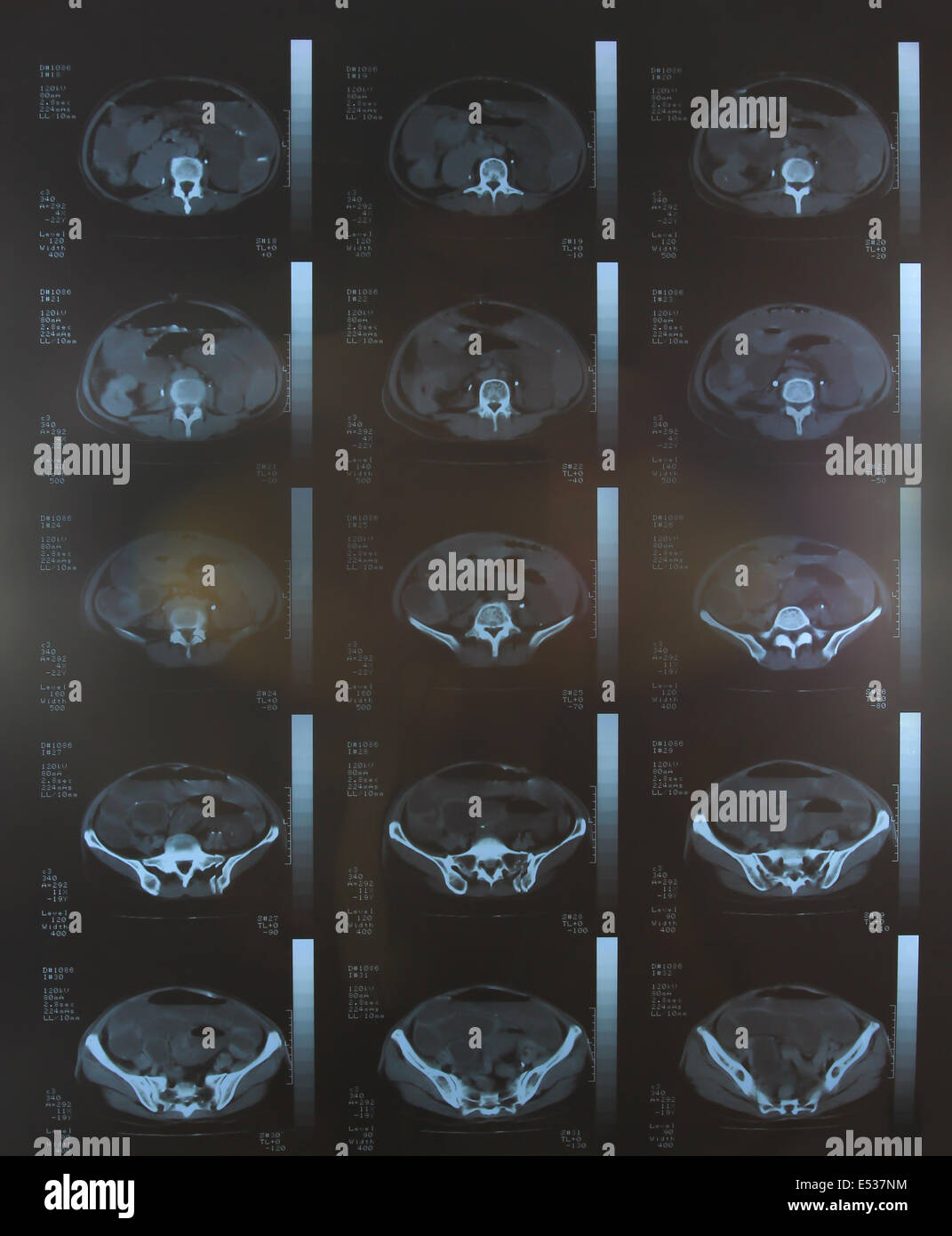 Libre d'un scanner CT avec le thorax et l'abdomen Banque D'Images