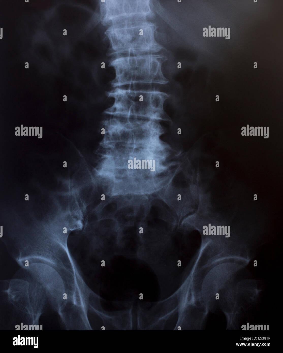 X-Ray Image de la poitrine pour un diagnostic médical. Banque D'Images