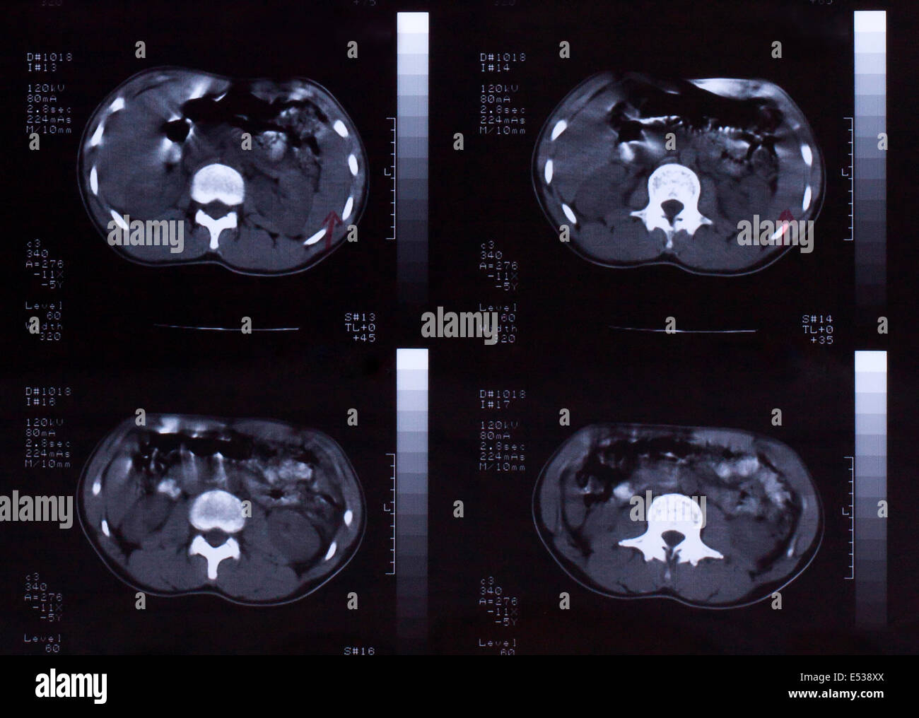 Libre d'un scanner CT avec la poitrine et l'abdomen, Banque D'Images