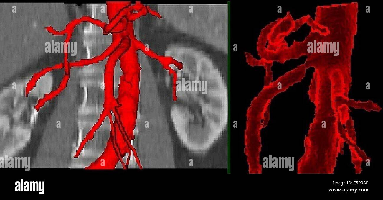 3D computed tomographic (CT) reconstruction d'un une sténose de l'artère mésentérique supérieure. Banque D'Images