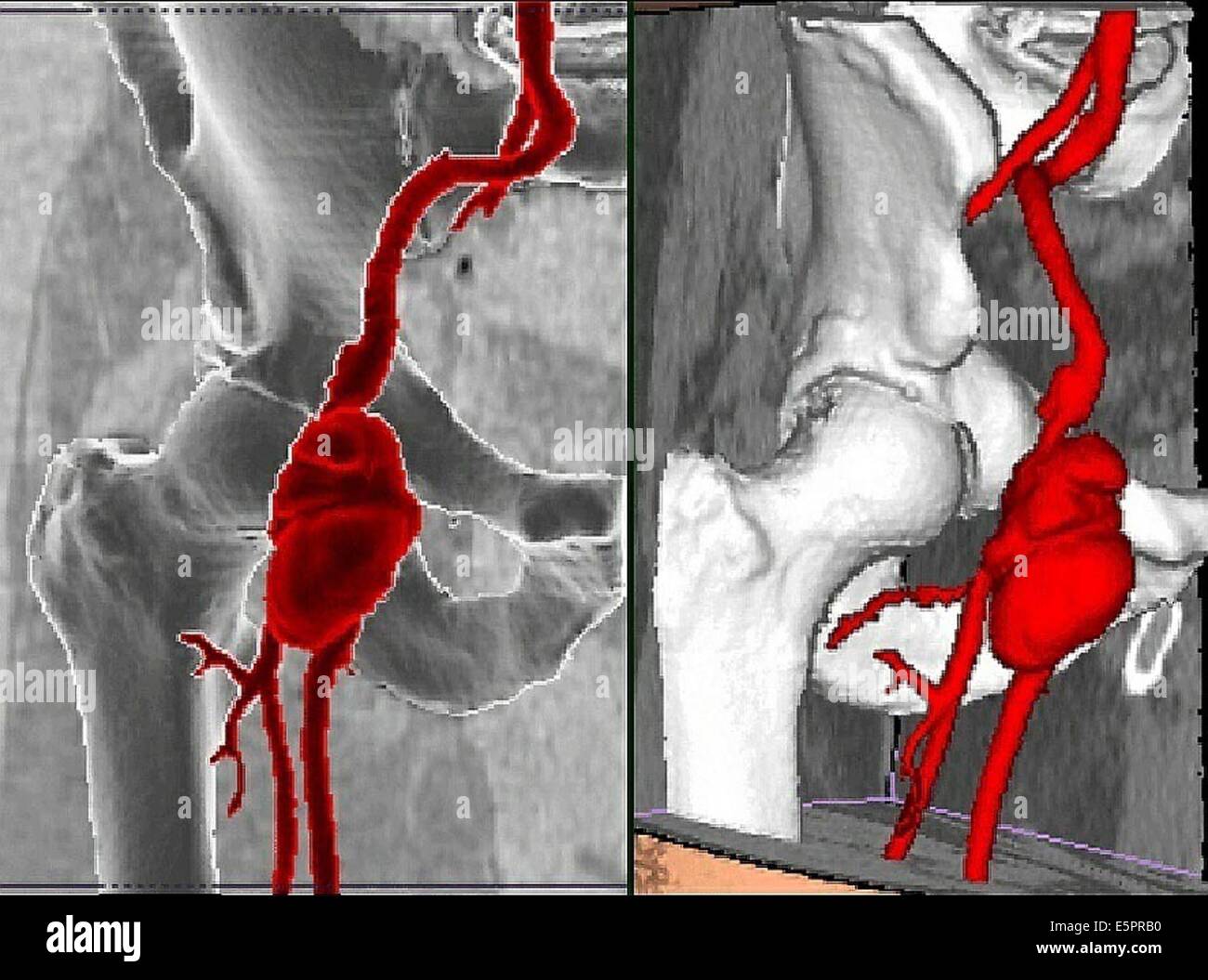 La tridimensionnelle (CT) de la reconstruction de l'artère fémorale droite anévrisme infectieux, il apparaît comme Banque D'Images La tridimensionnelle (CT) de la reconstruction de l'artère fémorale droite anévrisme infectieux, il apparaît comme Banque D'Images