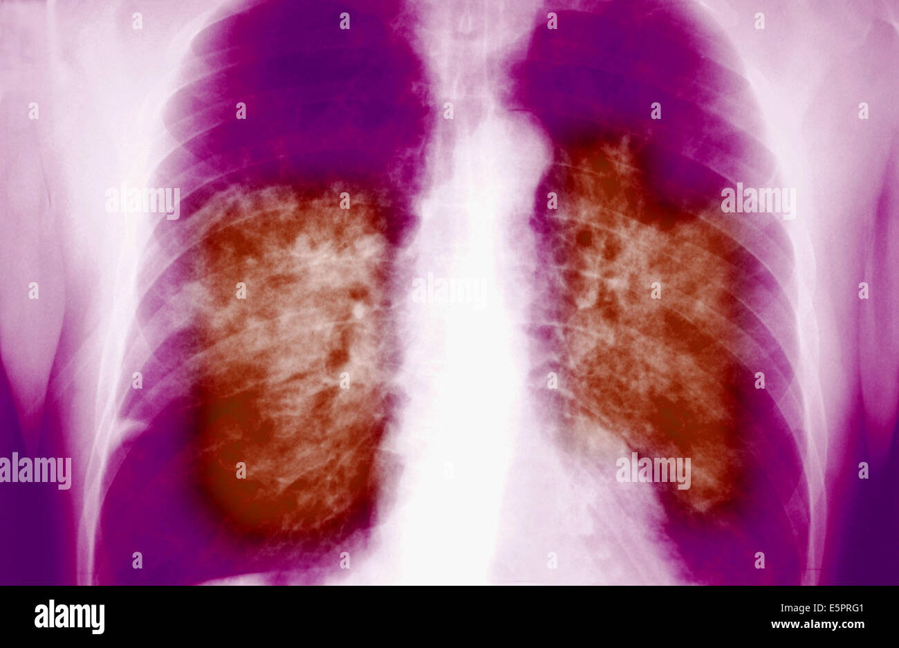 Radiographie montrant le syndrome respiratoire aigu sévère (SRAS). Banque D'Images
