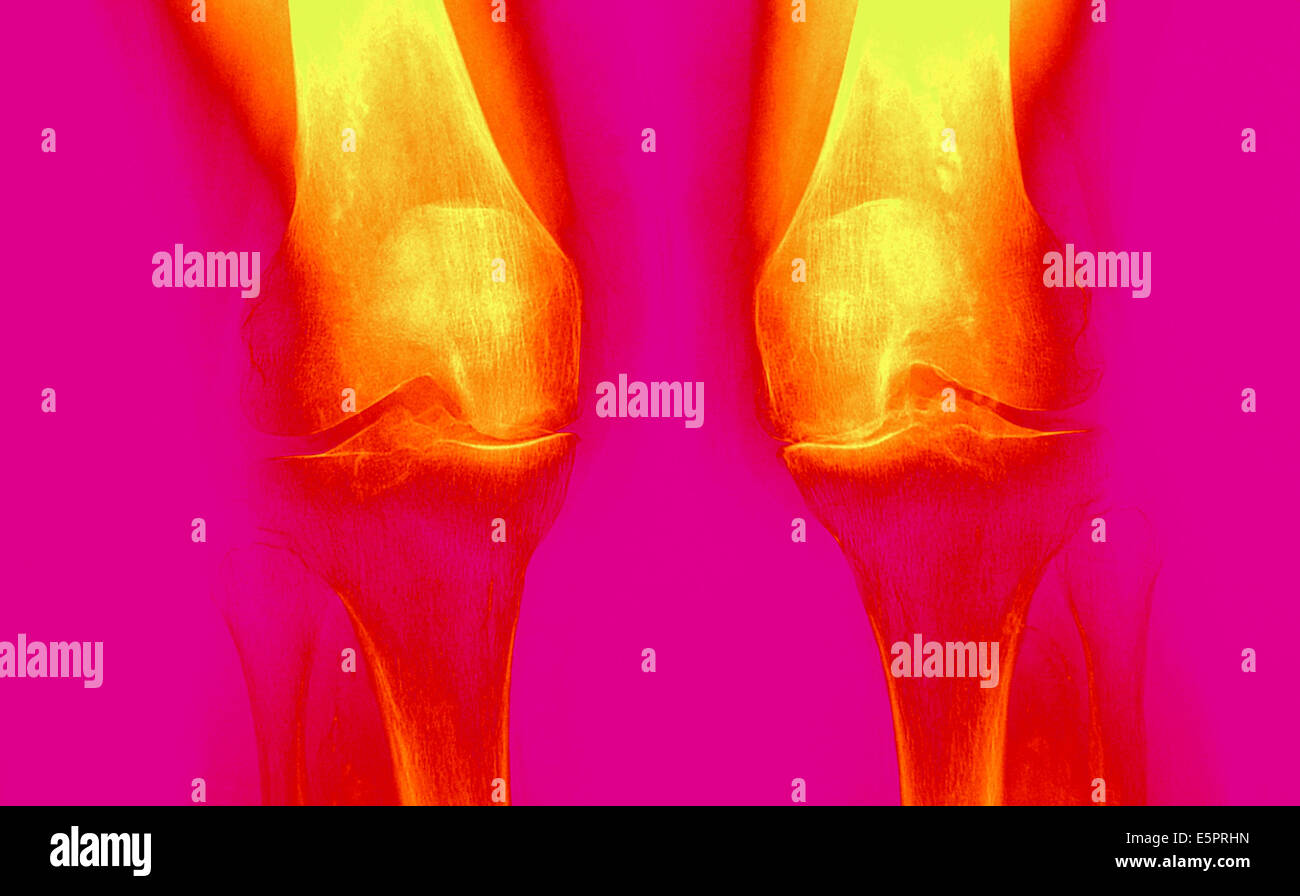 X-ray de genoux touchés par arthosis (vert). Banque D'Images