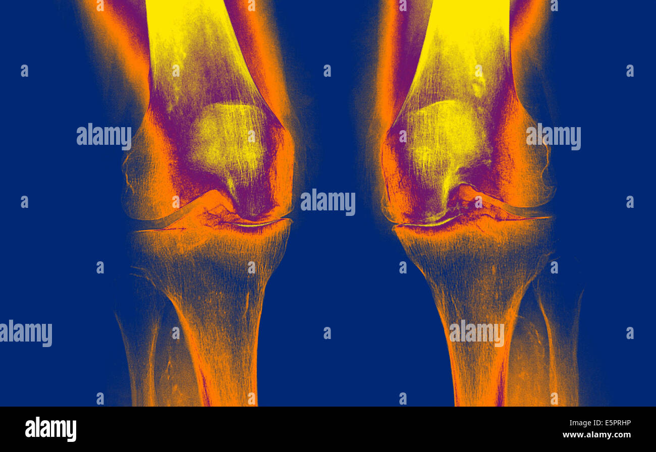 X-ray de genoux touchés par arthosis (vert). Banque D'Images