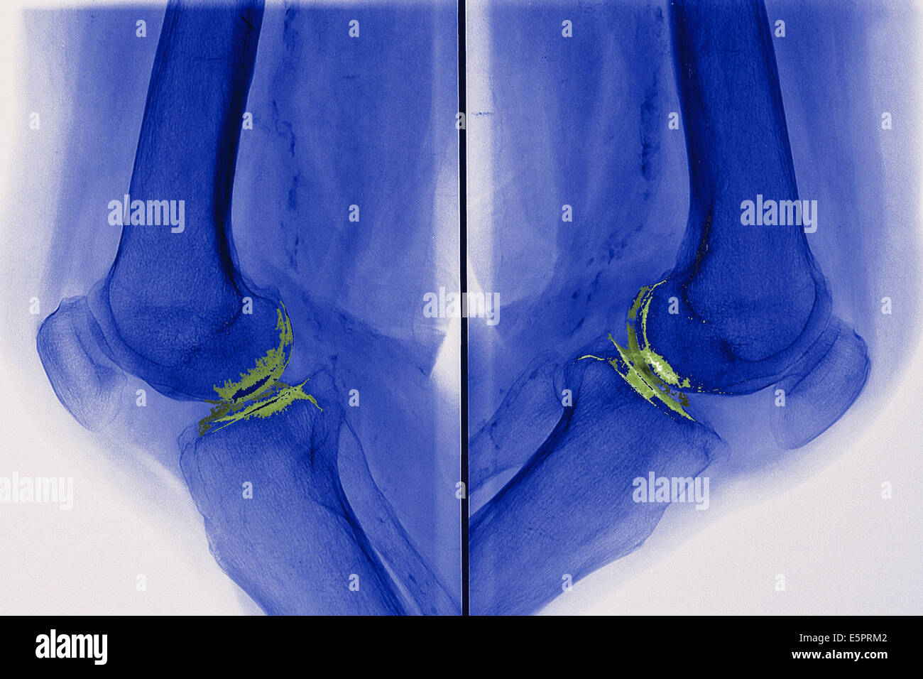 X-ray de genoux touchés par arthosis (vert), également appelé l'arthrose ou de la gonarthrose chez. Banque D'Images