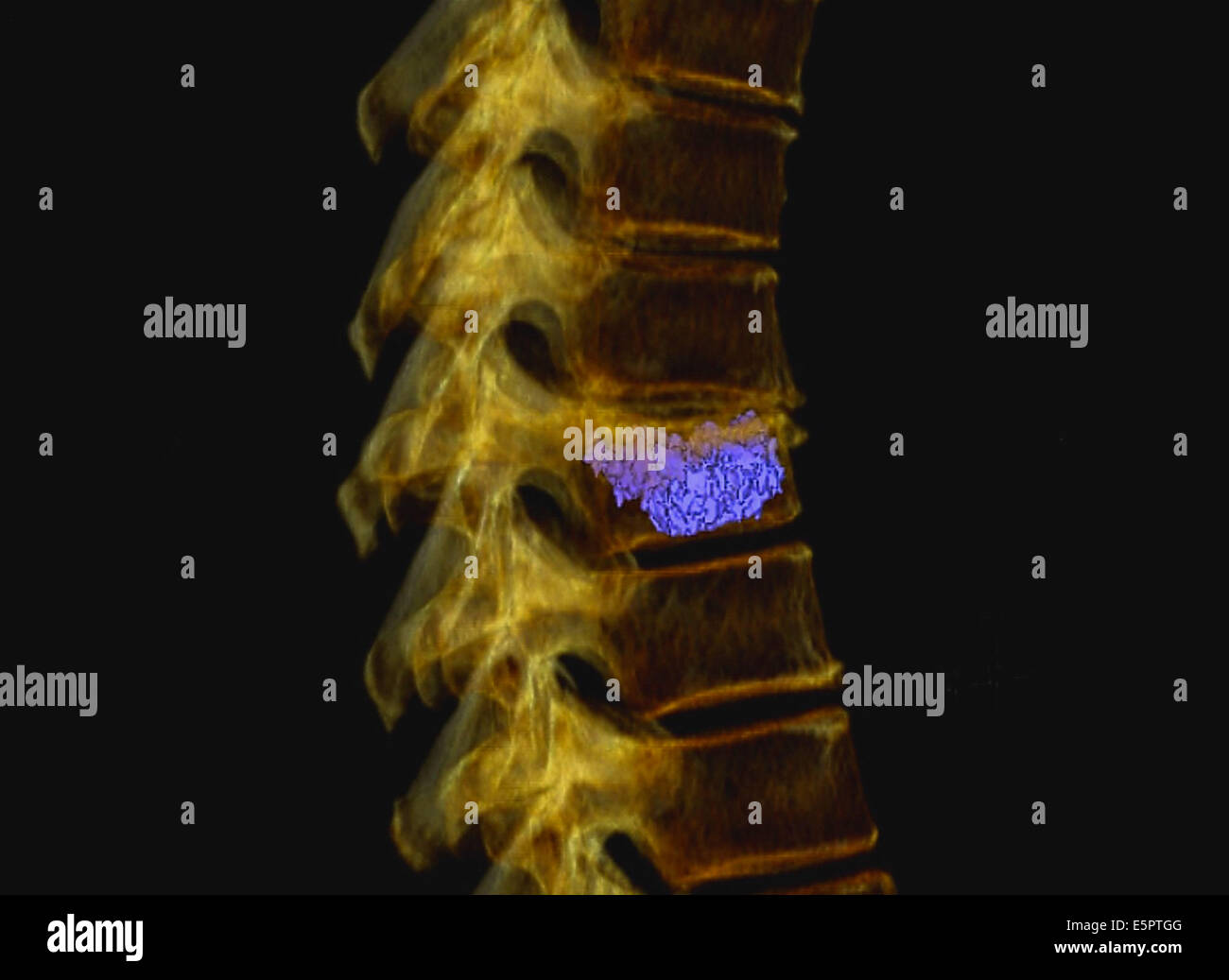 Ct Scan Vertebra Banque De Photographies Et D images Haute R solution ct-scan-vertebra-banque-de-photographies-et-d-images-haute-r-solution
