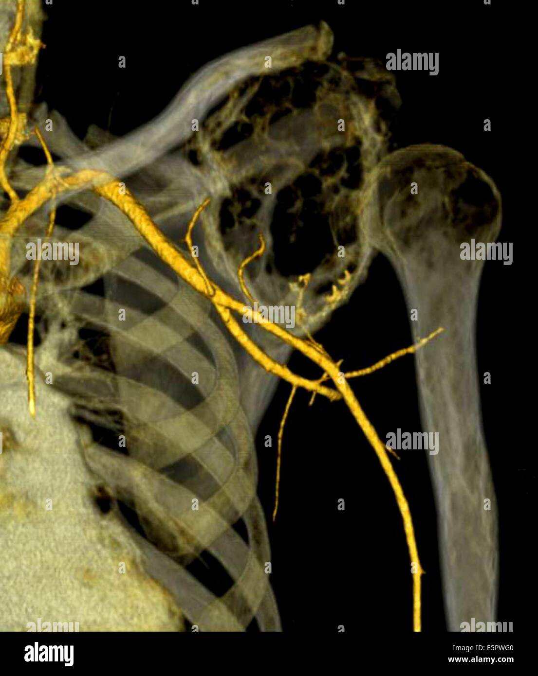 3D Computed Tomography (CT scan) la reconstruction de l'épaule ...