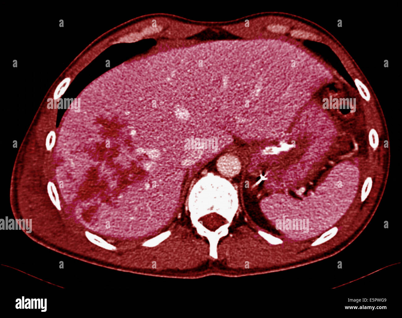 La tomographie axiale (scanner de l'abdomen montrant les ...