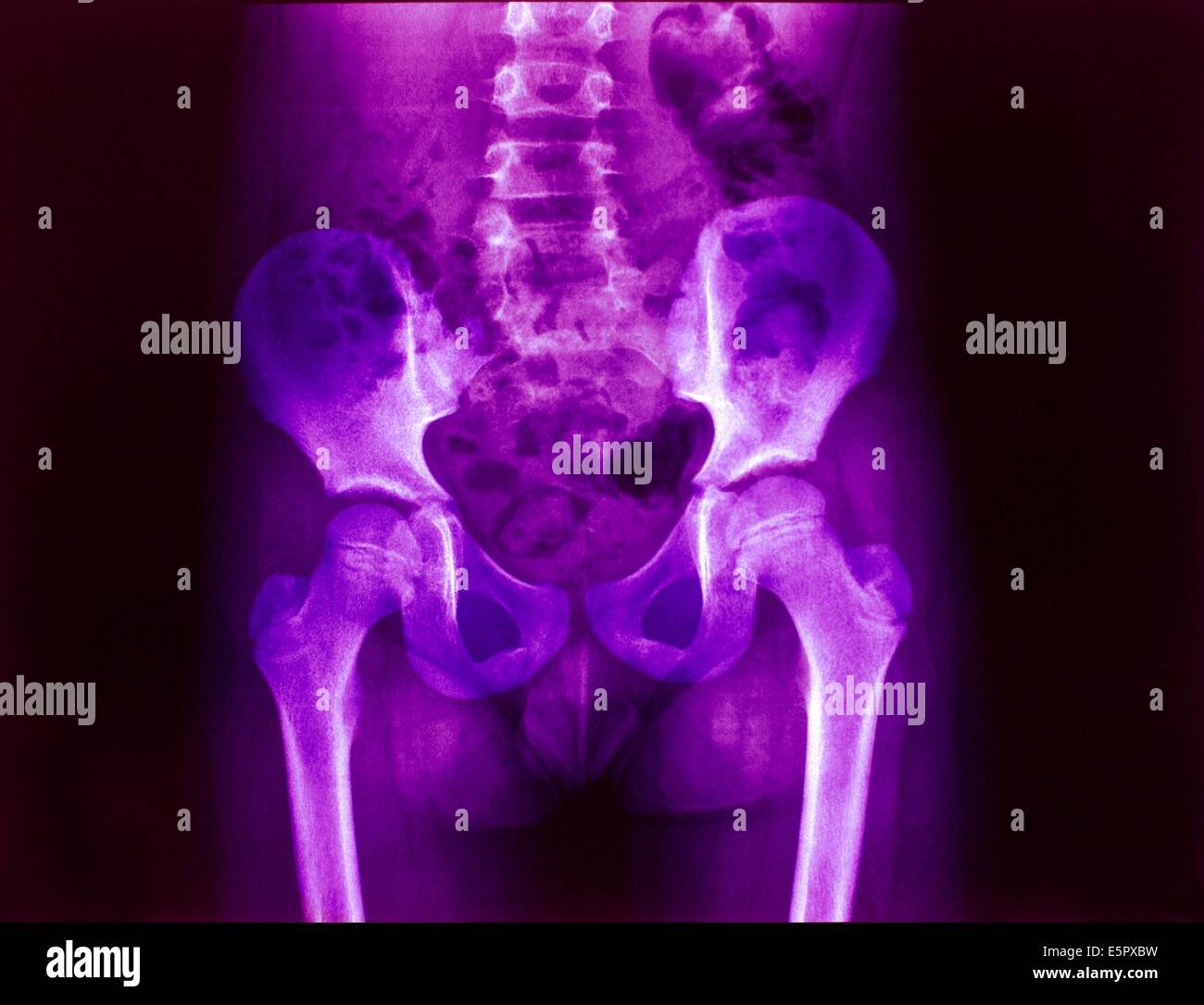 Radiographie d'un bassin normal d'un enfant Photo Stock - Alamy