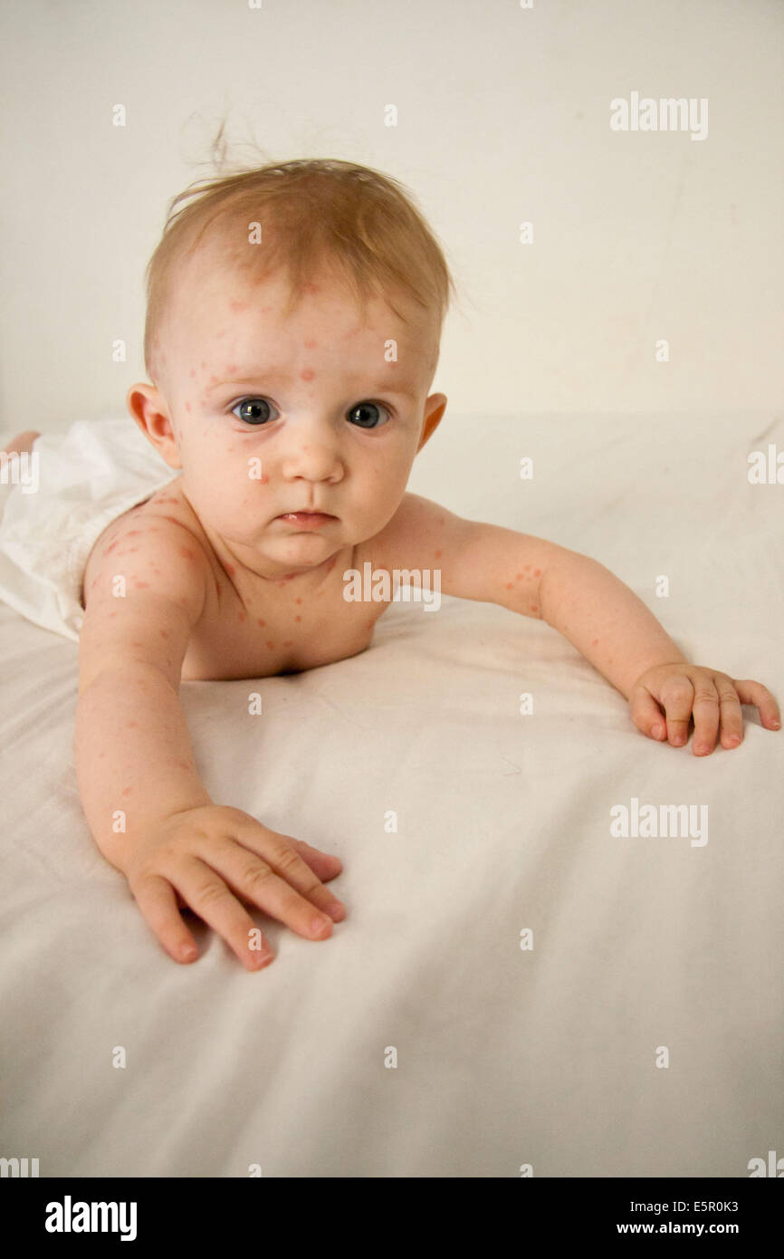 La Varicelle Sur Un Bebe De 4 Mois Photo Stock Alamy