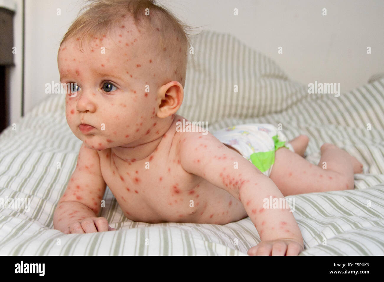 La Varicelle Sur Un Bebe De 4 Mois Photo Stock Alamy