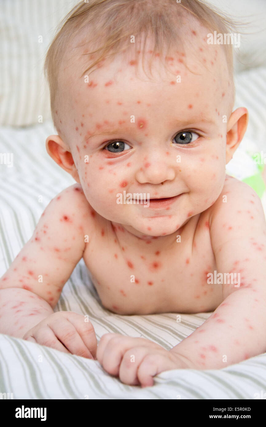 La Varicelle Sur Un Bebe De 4 Mois Photo Stock Alamy