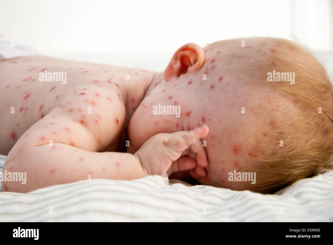 La Varicelle Sur Un Bebe De 4 Mois Photo Stock Alamy