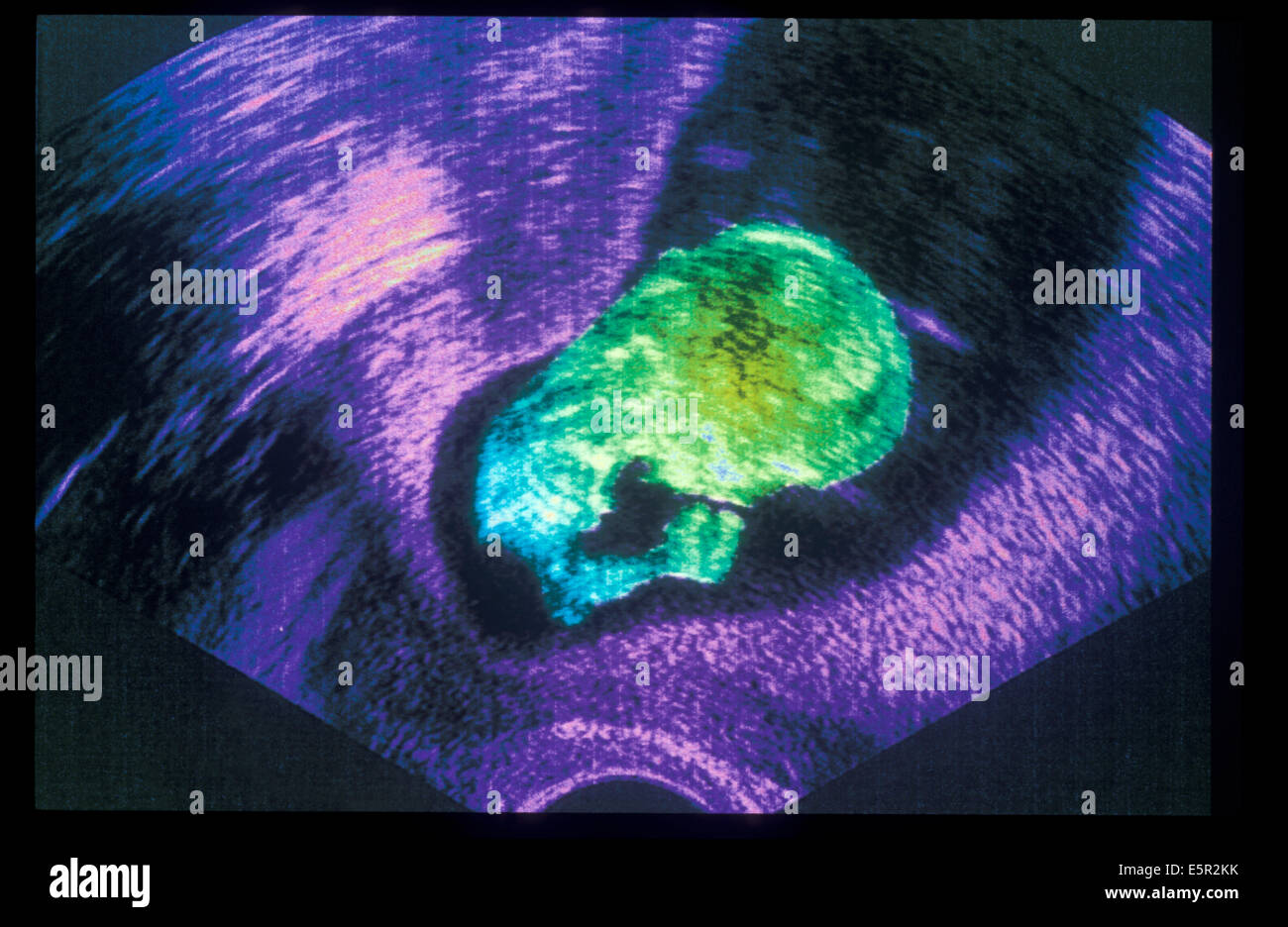 Ultrasound scan old foetus Banque de photographies et d’images à haute