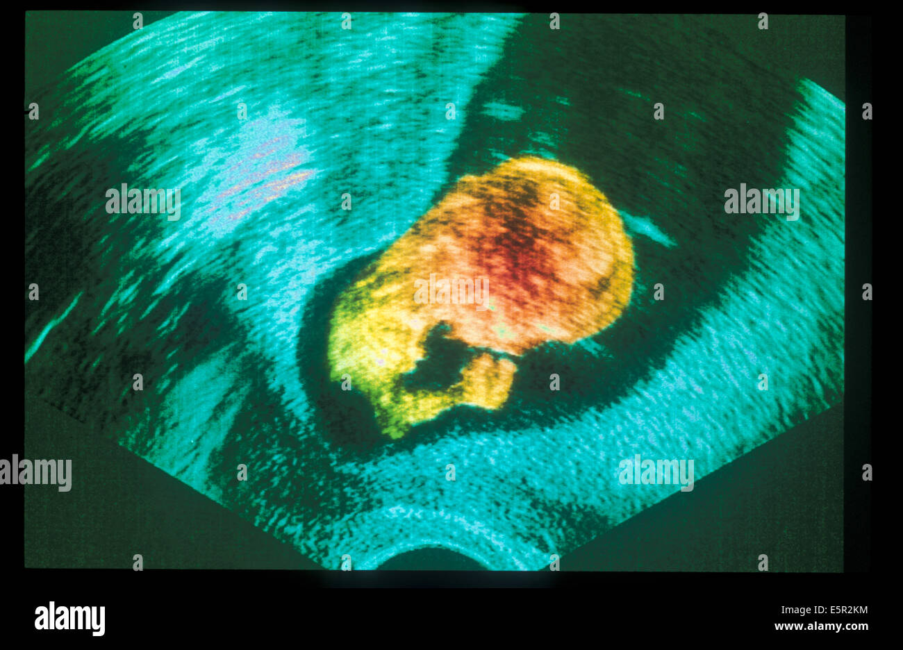 Ultrasound scan old foetus Banque de photographies et d’images à haute