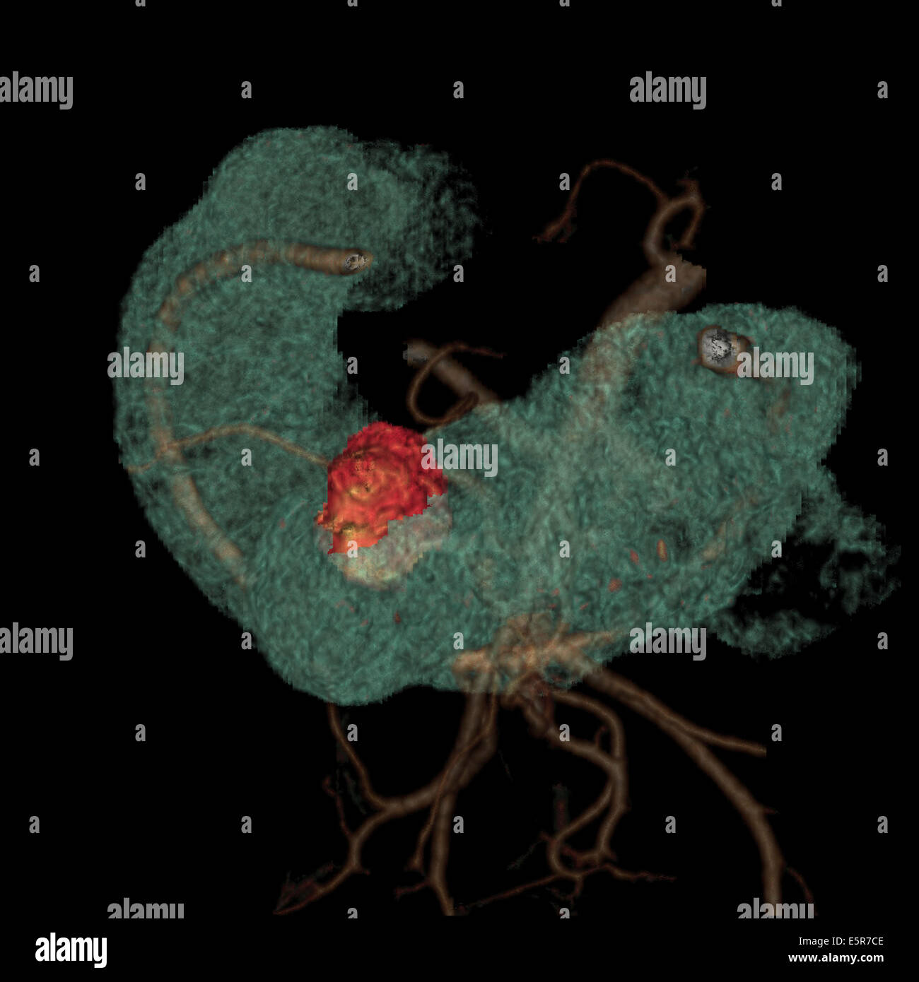 Trois dimensions de la numérisation de la reconstruction de l'intestin grêle montrant une tumeur stromale gastro-intestinale Banque D'Images