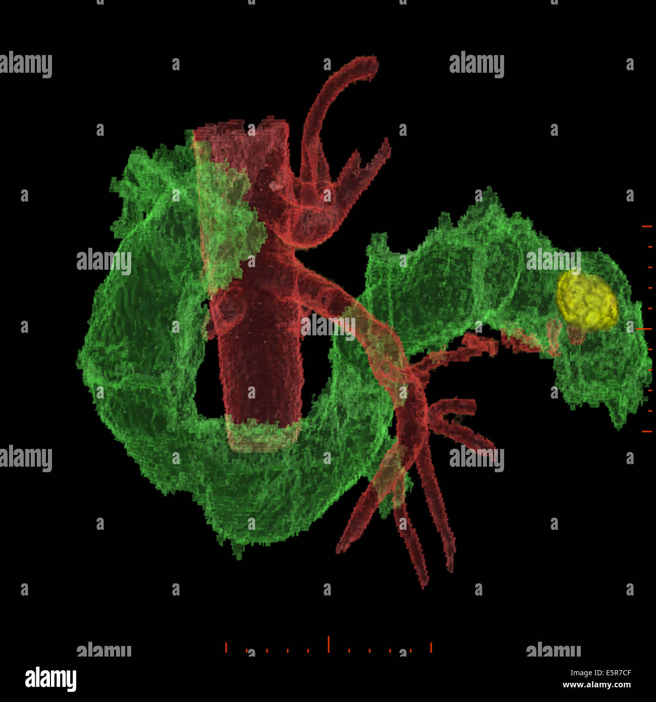 Trois dimensions de la numérisation de la reconstruction de l'intestin grêle montrant une tumeur stromale gastro-intestinale Banque D'Images