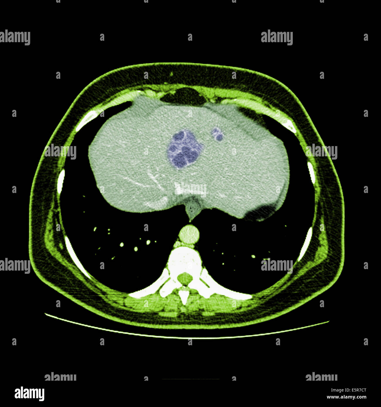 Le scanner (couleur) scan de l'abdomen (abces hépatique montrant ...