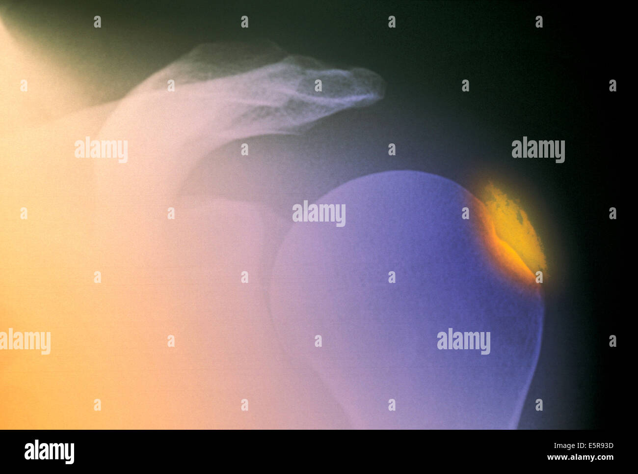 Renforcement de couleur radiographie de l'épaule avec la tendinite calcifiée. Banque D'Images