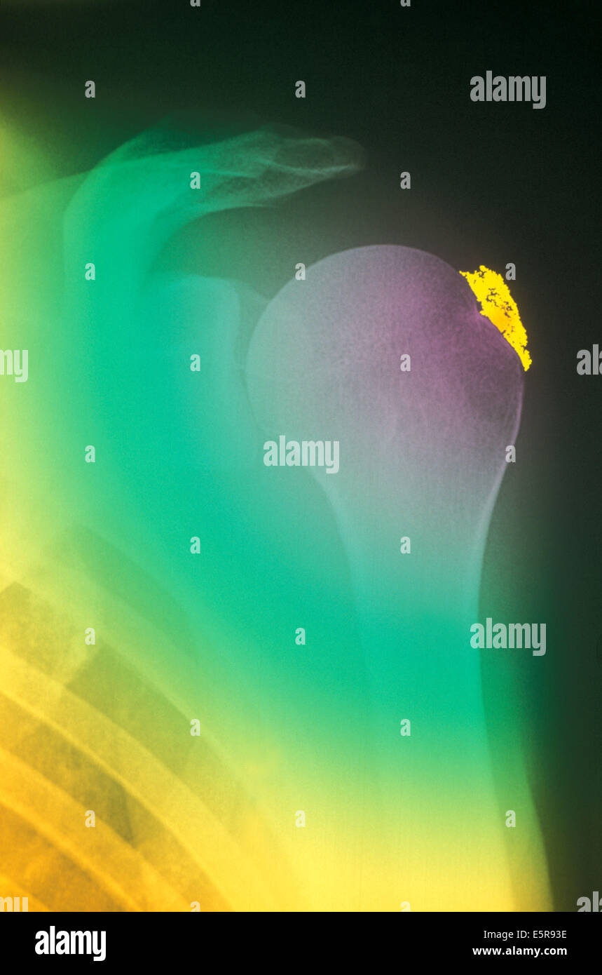 Renforcement de couleur radiographie de l'épaule avec la tendinite calcifiée. Banque D'Images