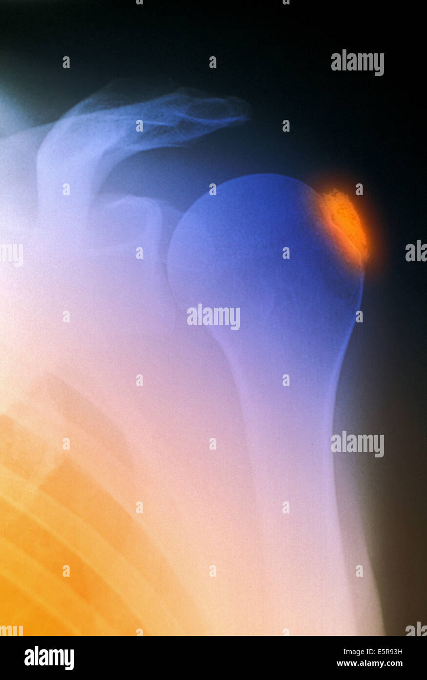 Renforcement de couleur radiographie de l'épaule avec la tendinite calcifiée. Banque D'Images