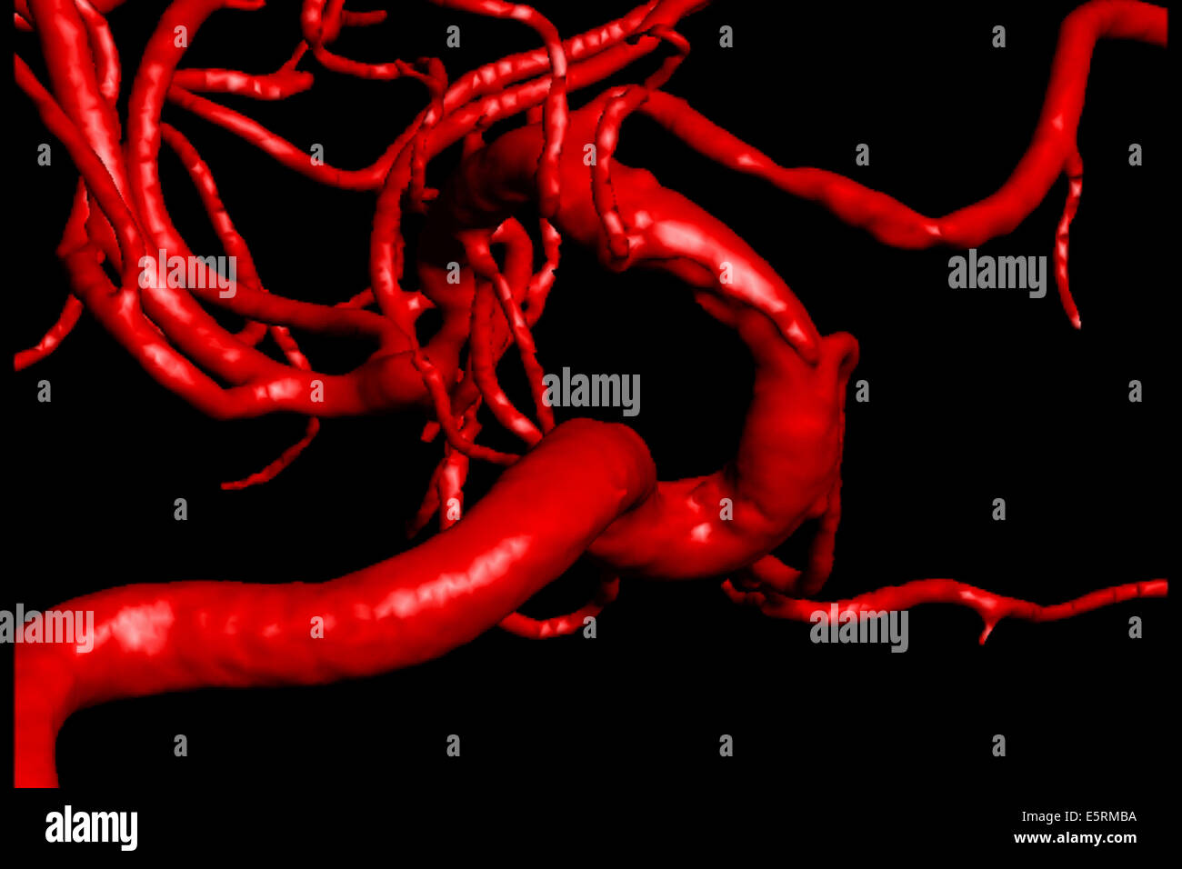 Traitement de la sténose carotidienne par angioplastie et stent prothèse, paramètre ici, reconstruction 3D des artères d'un patient après Banque D'Images