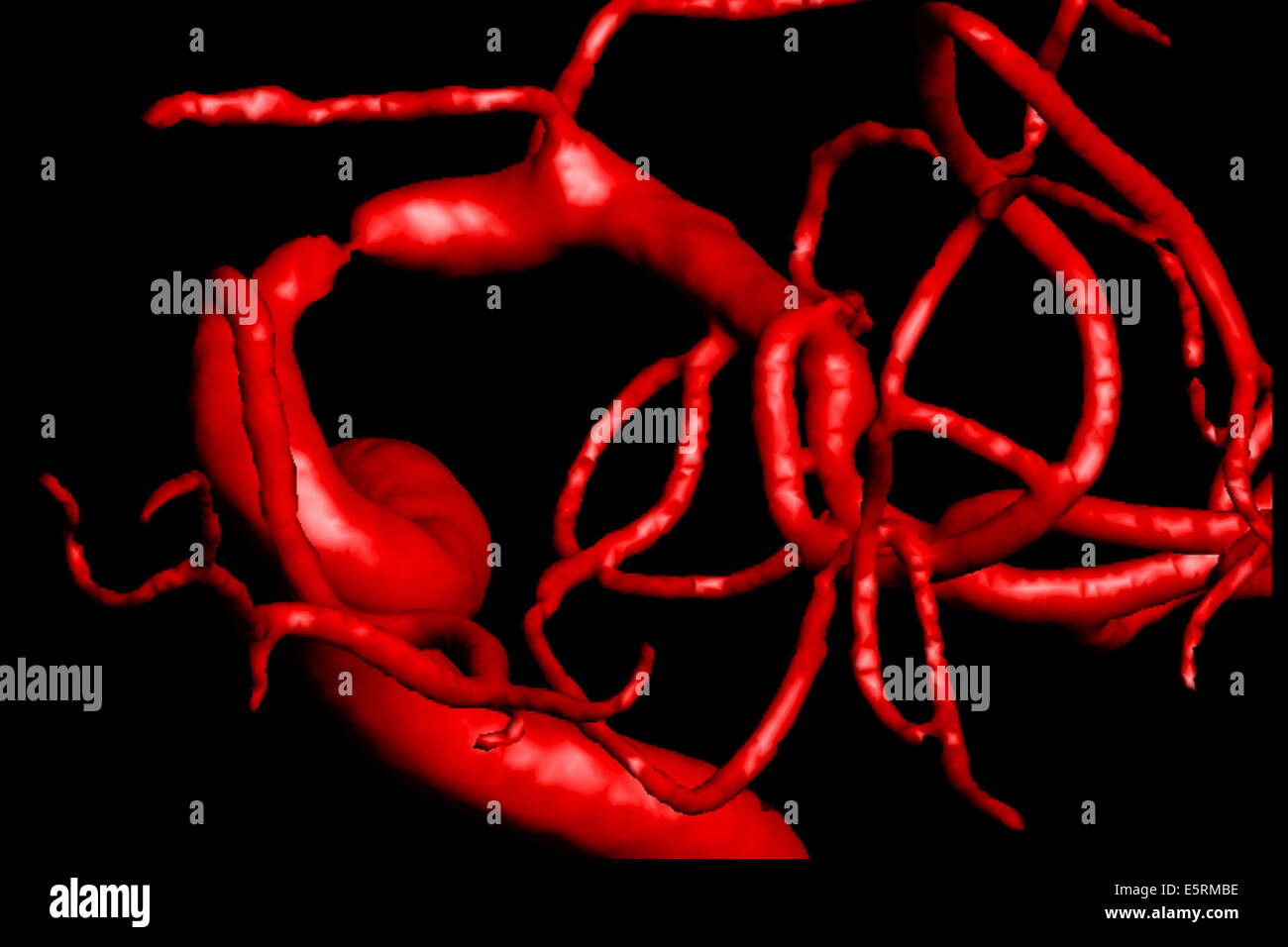 Traitement de la sténose carotidienne par angioplastie et stent prothèse, paramètre ici, reconstruction 3D des artères d'un patient avant Banque D'Images
