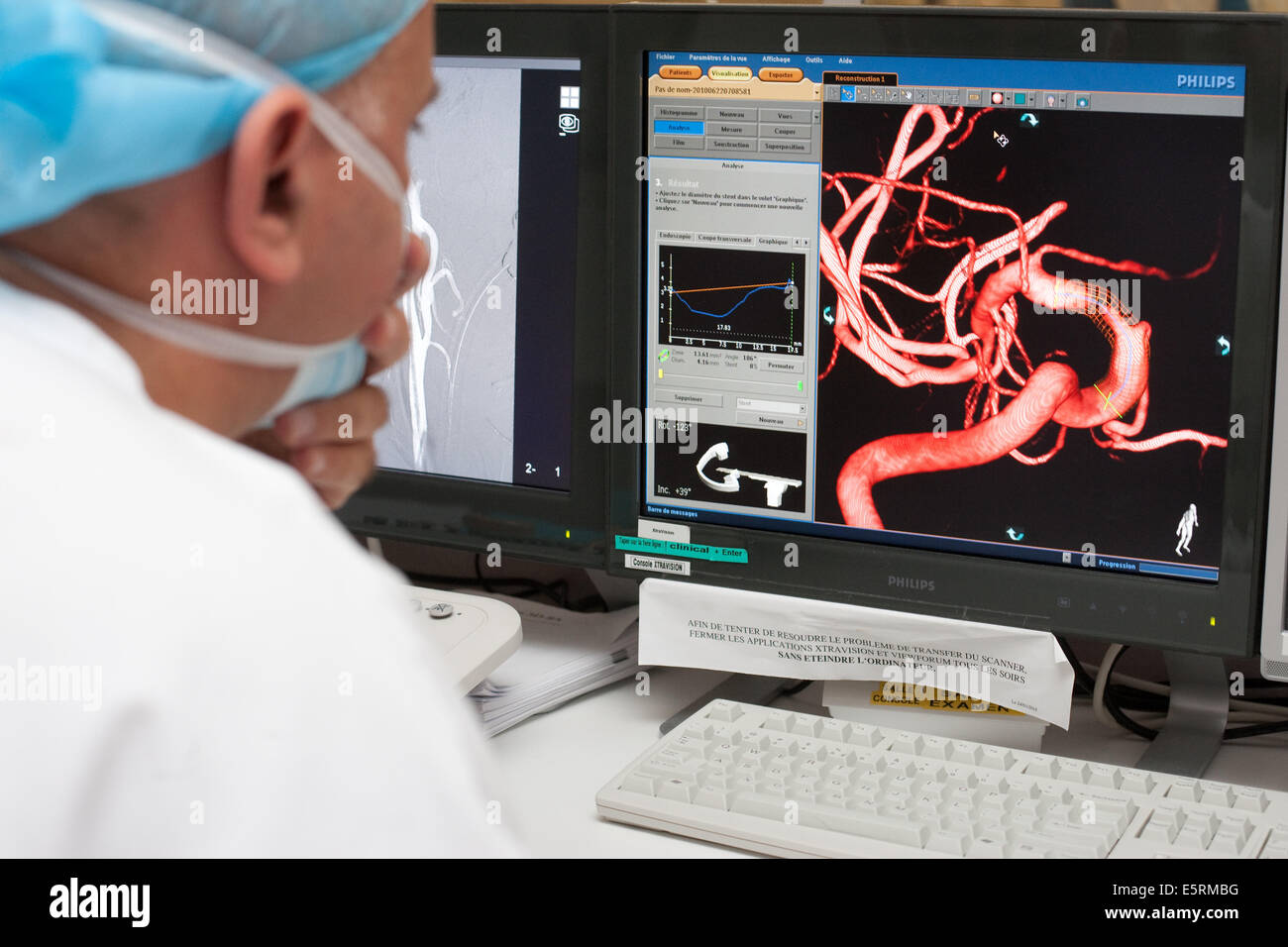 Traitement de la sténose carotidienne par angioplastie et stent prothèse, paramètre ici, reconstruction 3D pour choisir l'endoprothèse virtuelle Banque D'Images