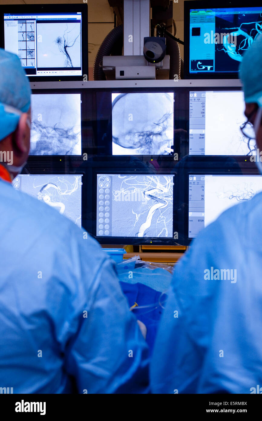 Traitement de la sténose carotidienne par angioplastie et stent réglage prothèse, ici, d'un cathéter inséré dans une veine sous Banque D'Images