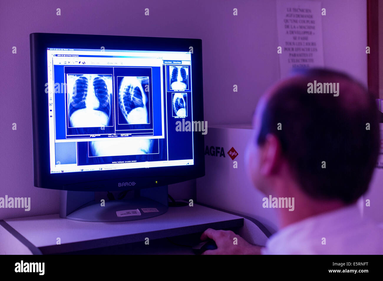 Radiographie thoracique d'une jeune fille de 13 ans souffrant de mucoviscidose. L'hôpital de Limoges, France. Banque D'Images