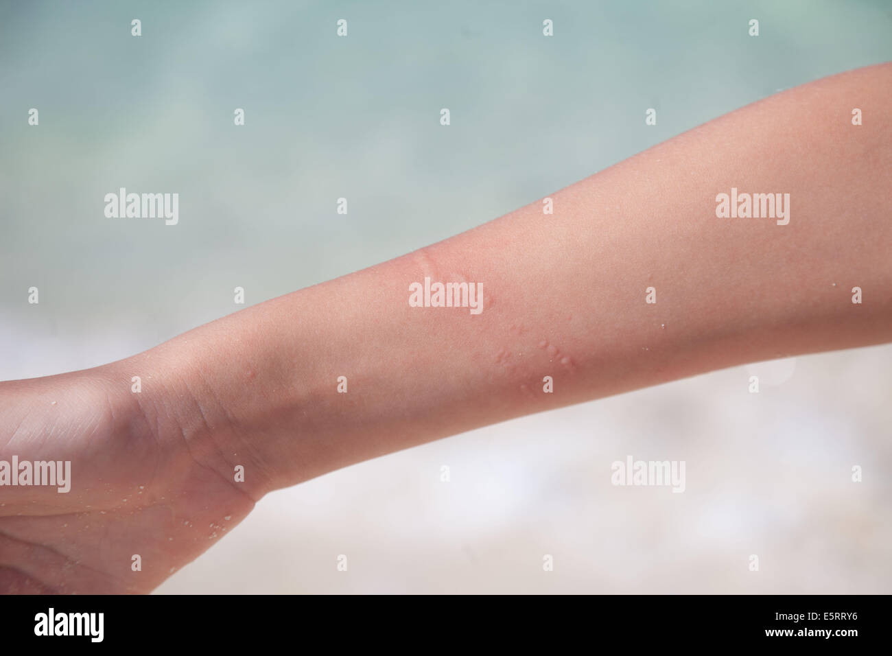 Jellyfish Sting Banque D Image Et Photos Alamy