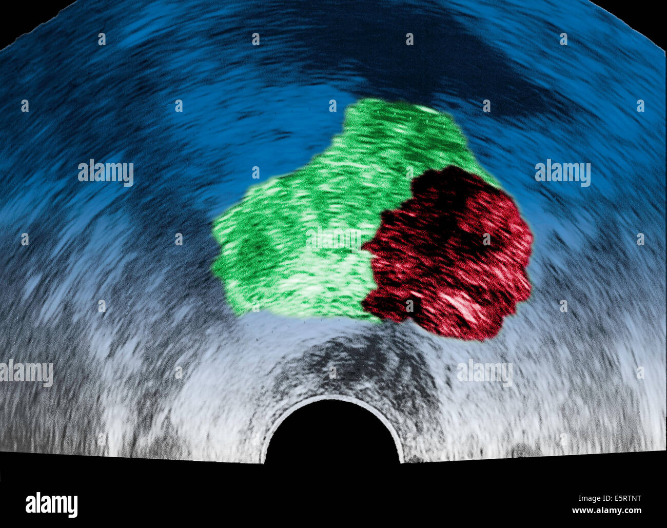 Échographie d'un cancer de la prostate, vu en rouge. Banque D'Images