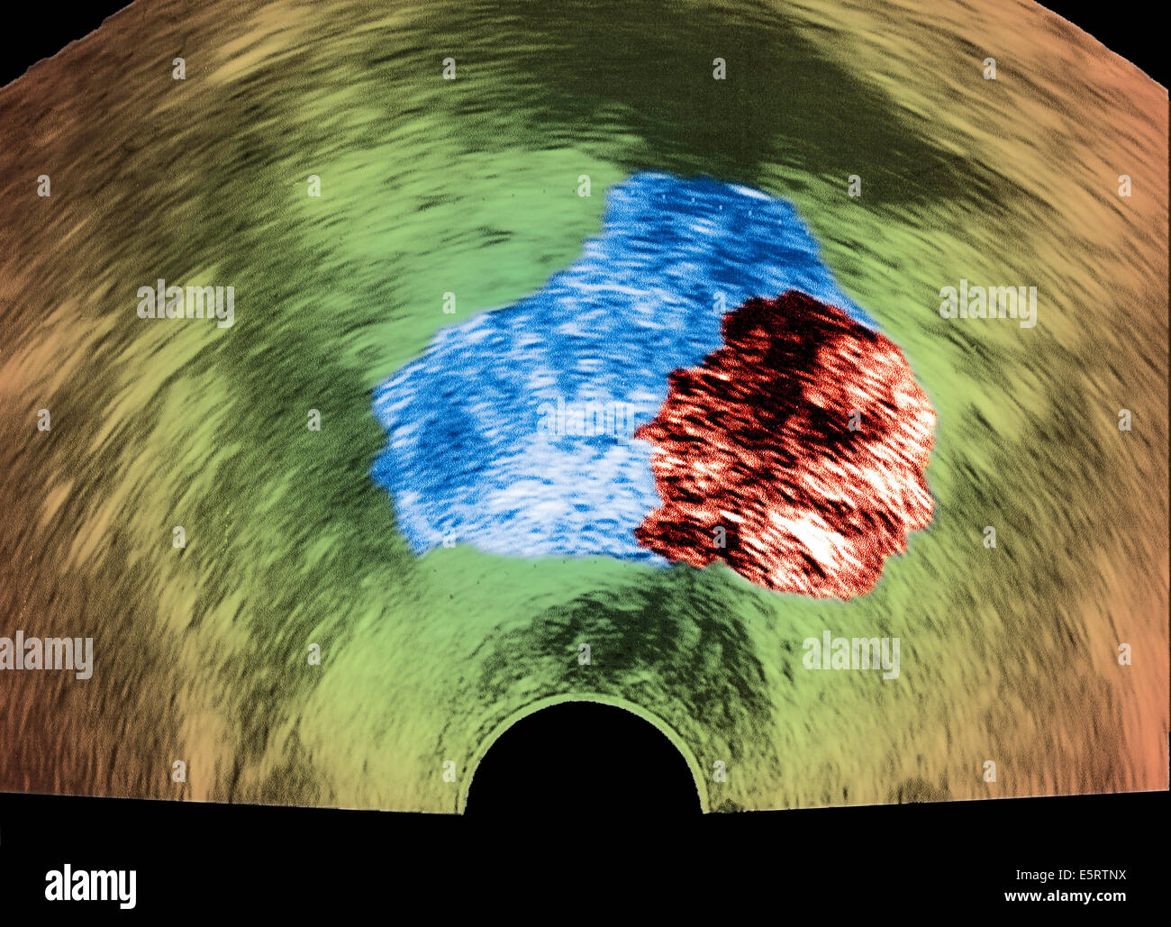 Échographie d'un cancer de la prostate, vu en rouge. Banque D'Images