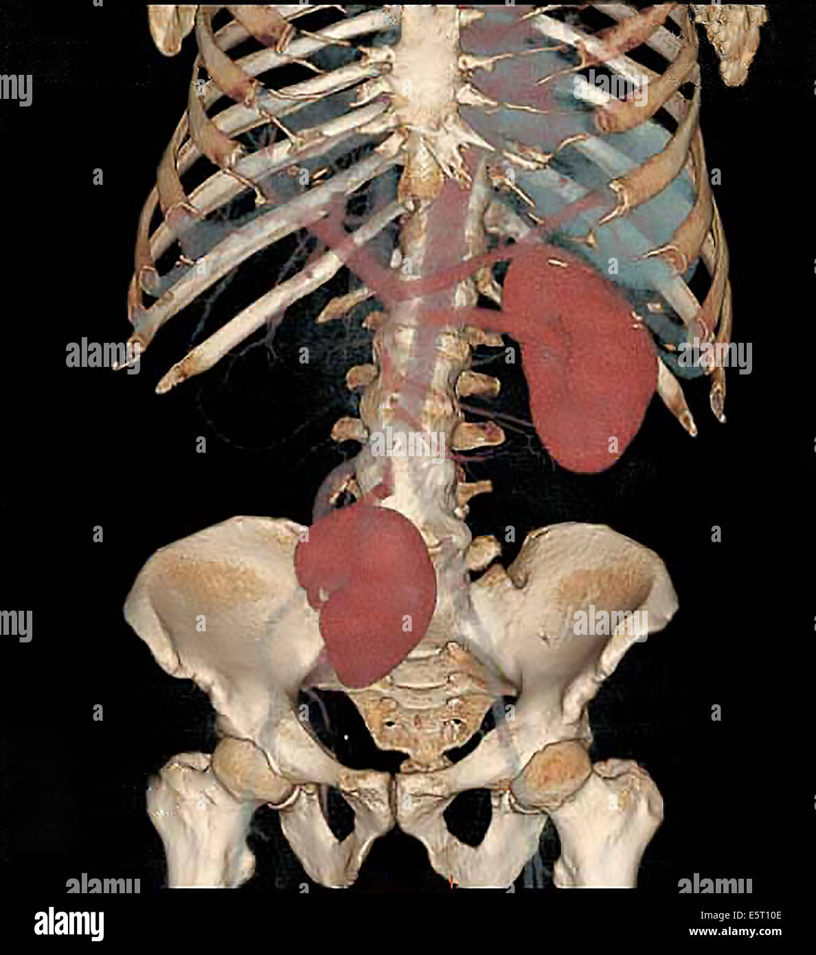 3-couleur D computed tomography (CT) d'un rein ectopique unilatérales dans le bassin. Banque D'Images