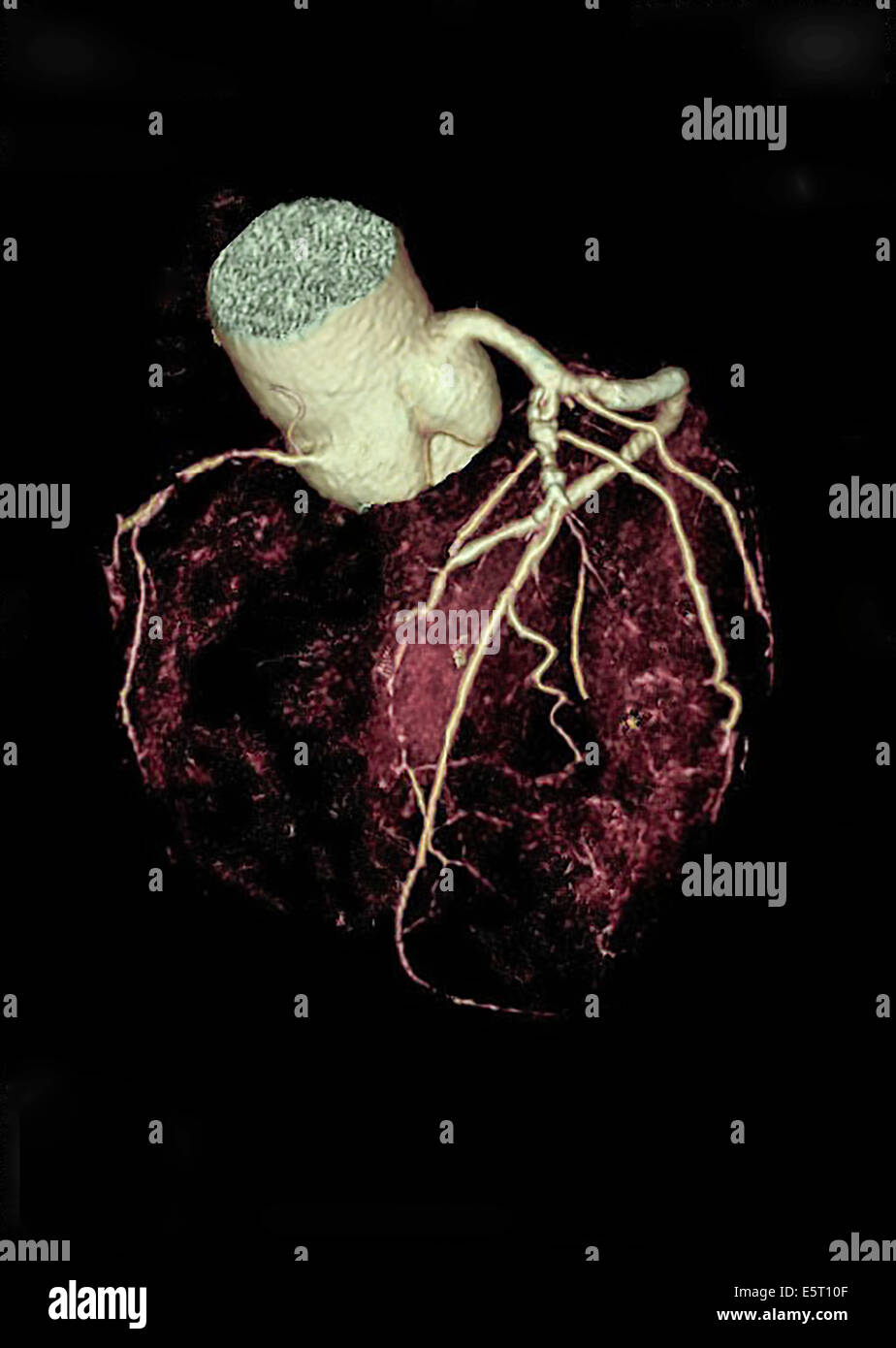 3-D de couleur la tomodensitométrie (TDM) du coeur montrant la sténose des artères coronaires multiples rétrécie par Banque D'Images