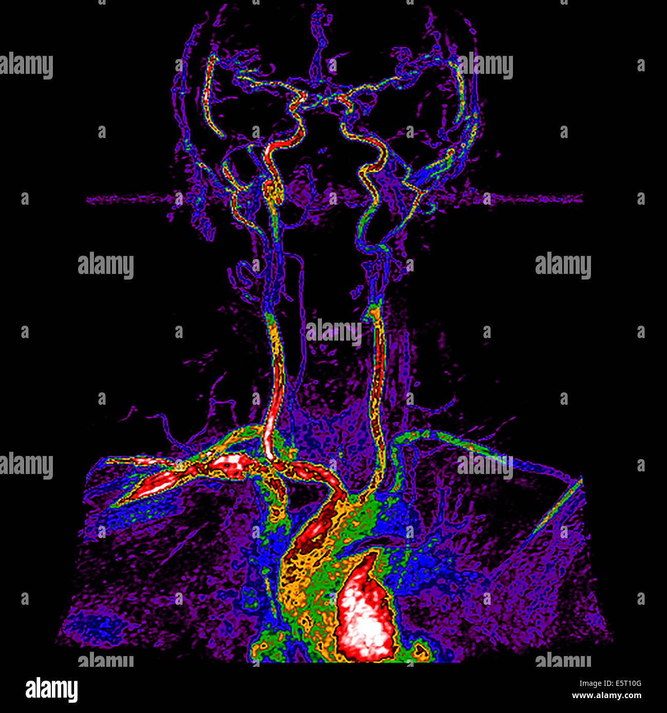 Les troncs supra-aortiques (TSA) montrant les branches collatérales de l'aorte de l'arc aortique : l'artère brachiocéphalique Banque D'Images