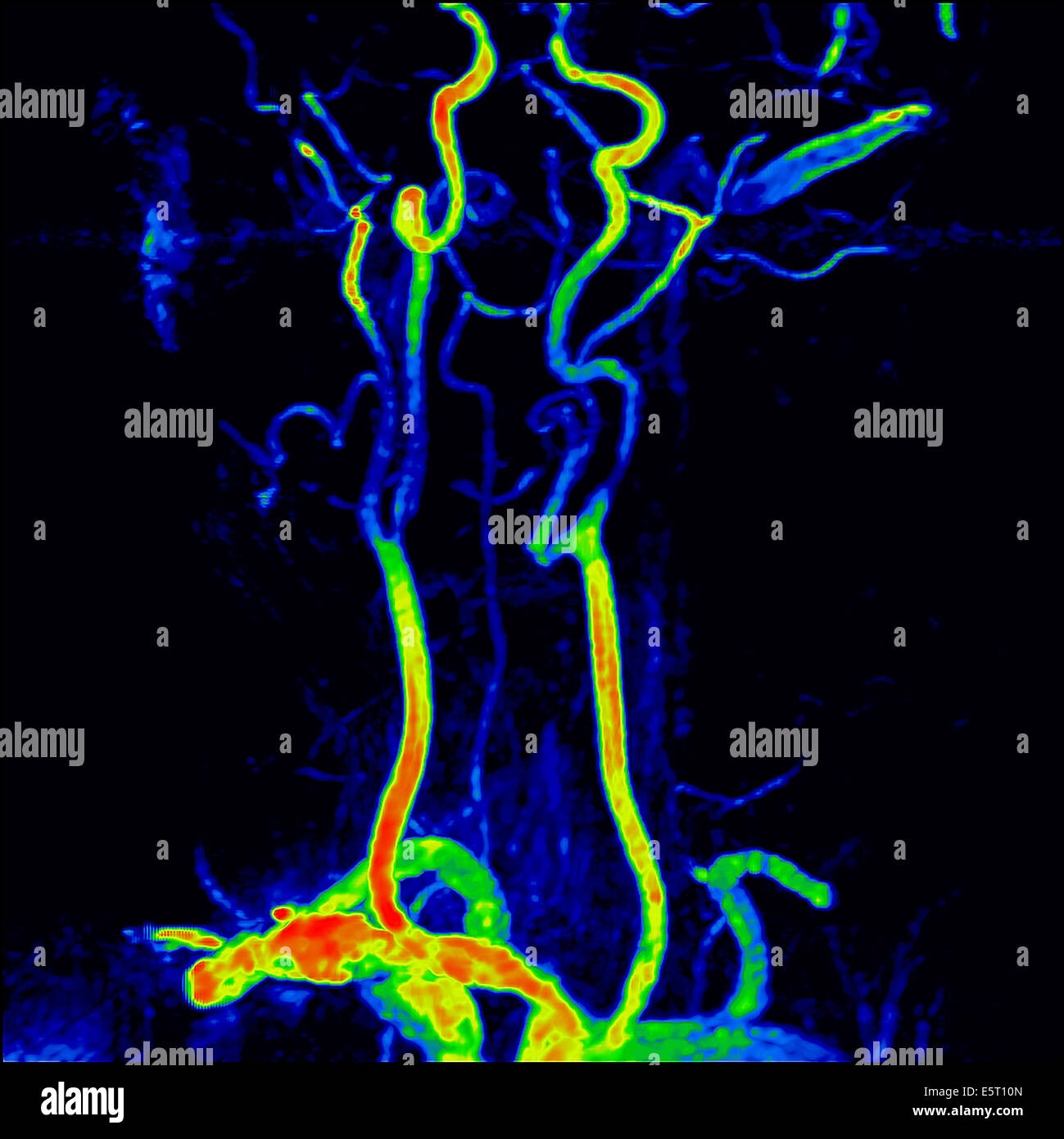 Les troncs supra-aortiques (TSA) montrant les branches collatérales de l'aorte de l'arc aortique, l'artère brachiocéphalique Banque D'Images