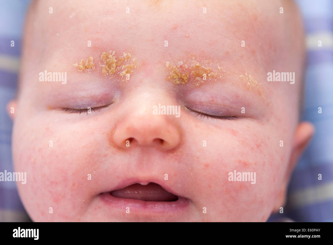 Dermatite Séborrhéique Infantile Banque d'image et photos - Alamy