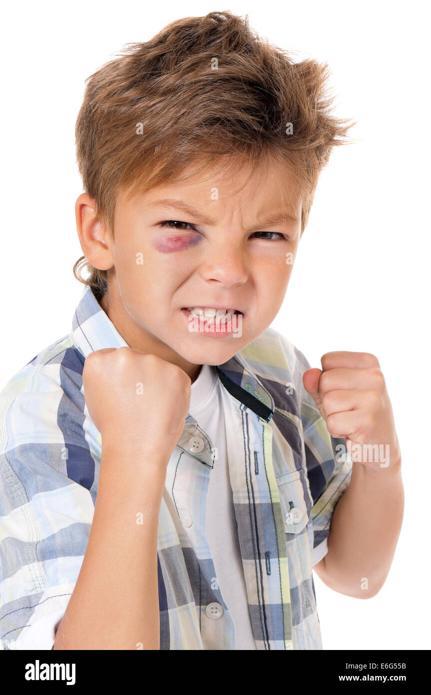 Garçon avec ecchymose Banque D'Images