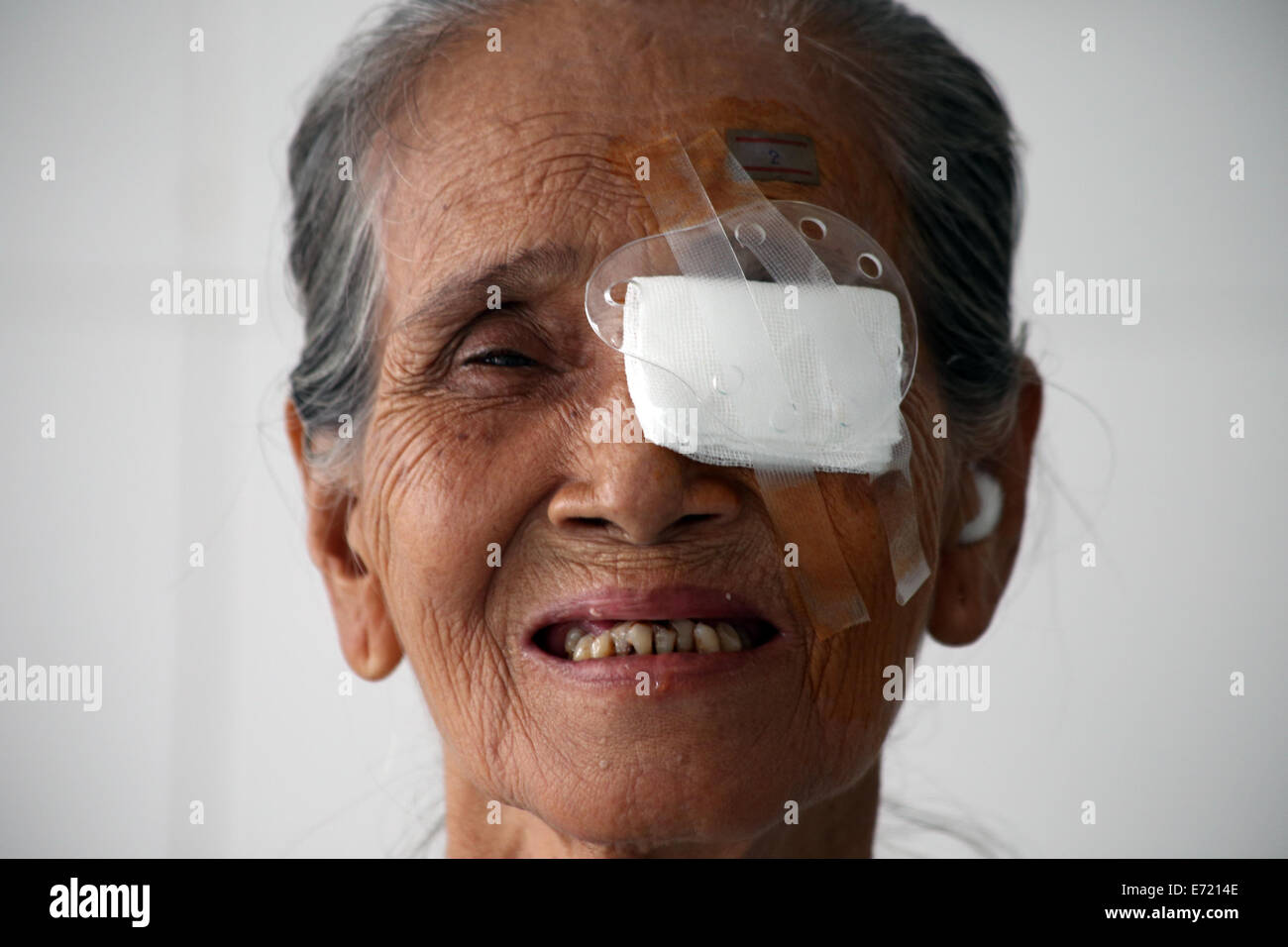 Yangon, Myanmar. 16Th Jun 2014. Un patient porte un pansement oculaire après la chirurgie à Yangon, Myanmar, le 4 septembre 2014. Une équipe médicale chinoise a commencé une campagne de traitement chirurgical de l'œil à Yangon jeudi que la troisième du genre de 'Action' de la luminosité dans le pays. Credit : U Aung/Xinhua/Alamy Live News Banque D'Images
