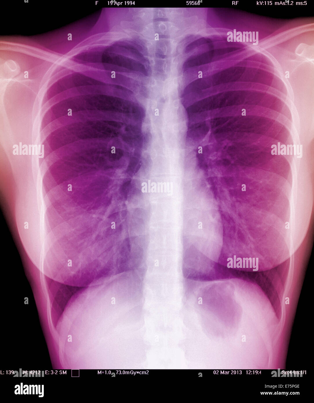 Pulmonaire, une radiographie Banque D'Images