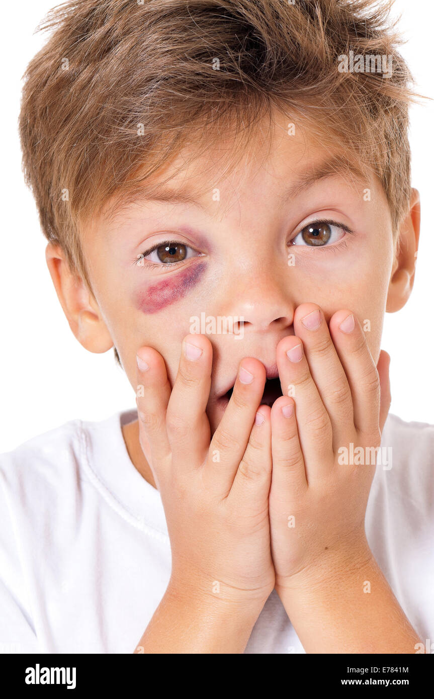 Garçon avec ecchymose Banque D'Images