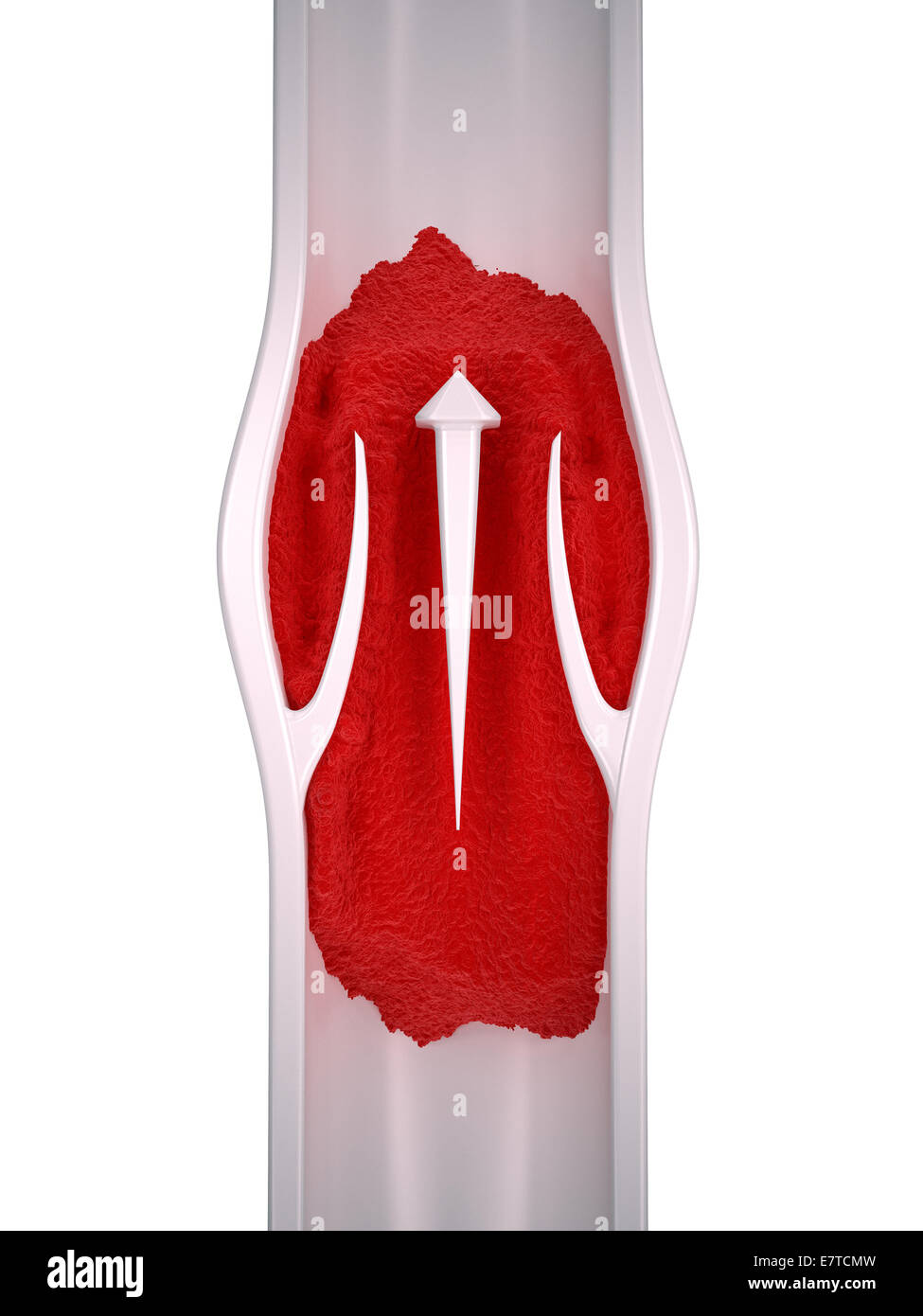 Le thrombus - anatomie d'une thrombose veineuse profonde Banque D'Images