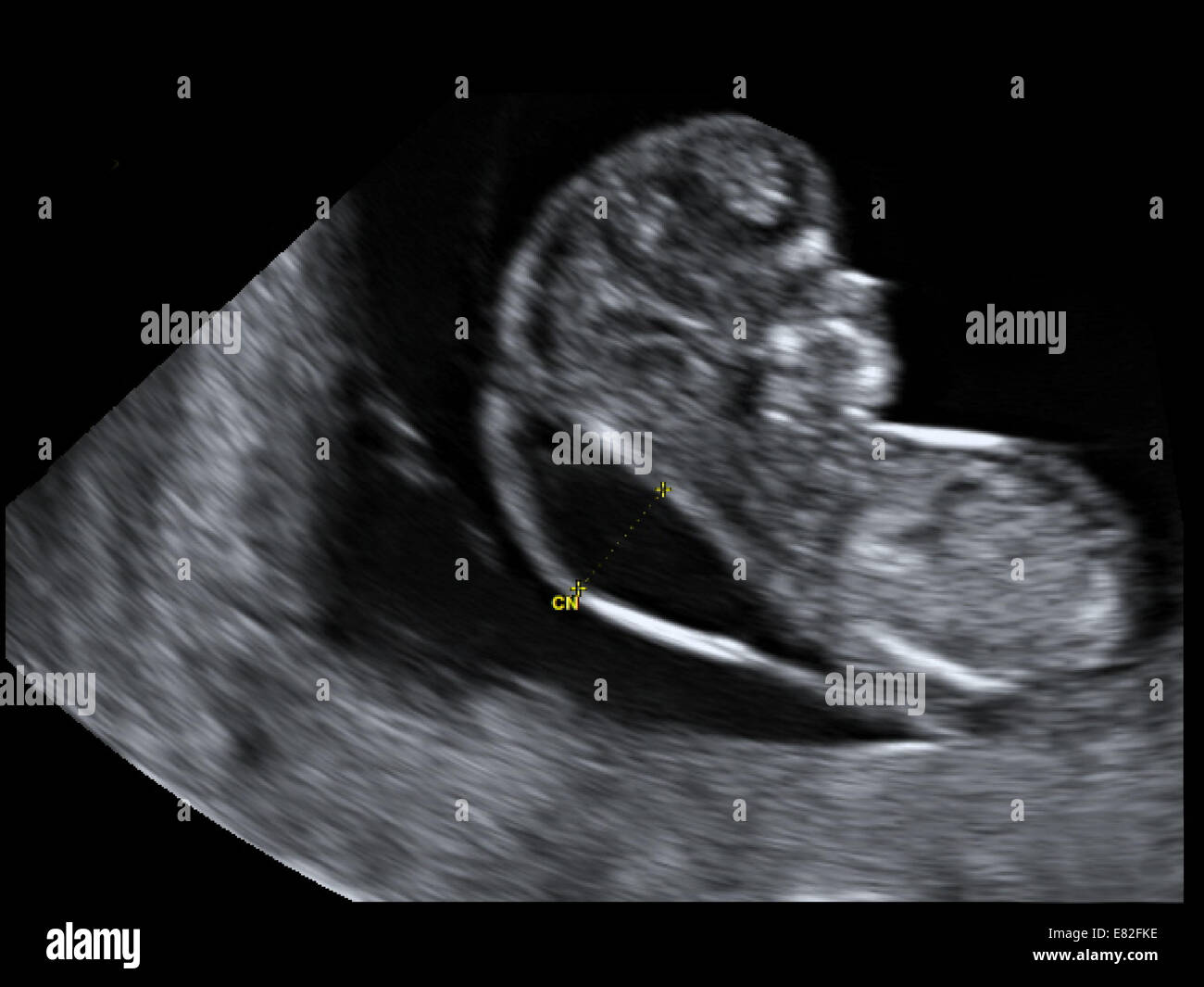 Echographie D Un Fœtus Montrant Nuchal Du Scan Pour Le Syndrome De Down L Age Gestationnel 12 Semaines Et 2 Jours Photo Stock Alamy