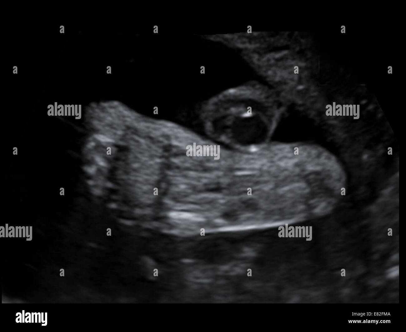 Echographie D Un Fœtus Pied Age Gestationnel 31 Semaines Et 5 Jours Photo Stock Alamy